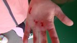 Девочка поранила руку на детской площадке