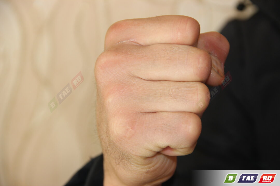 Гайчанин сломал своему оппоненту челюсть и ребро